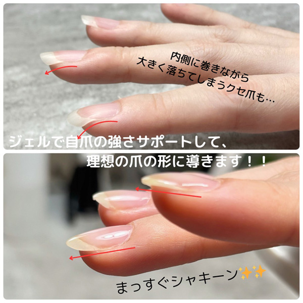 クセ爪と美爪のビフォーアフター